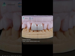 EMAX Veneer Alam yang Ditekan Kekuatan 16 Nuansa Emax Veneer Gigi