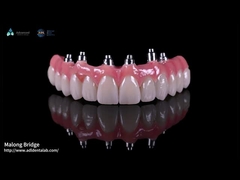 Hybrid Pink Porcelain Implant Crown Malong Full Arch Implant Bridge Pengisian segera