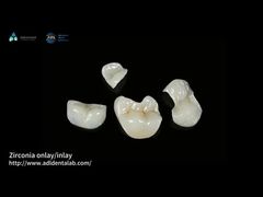 Translucent Onlay Zirconia Inlay untuk tahan noda dan keausan yang tahan lama
