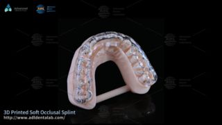 Belat Cetak 3D Khusus untuk Kenyamanan Bruxism