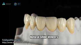 Veneer Senyum Alami Keramik Feldspathic Tembus Tinggi