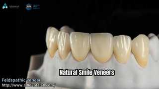 Veneer Tampilan Alami Keramik Feldspathic 0,3-0,7mm