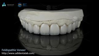 Veneer Keramik Feldspathic Tembus Tinggi untuk Senyuman