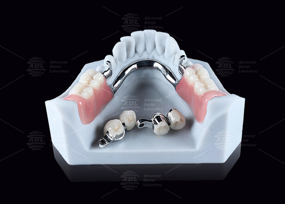 Beli CEKA M2 Precision Attachment Titanium Dengan 3mm Horizontal / Vertikal Clearances pembuatan online