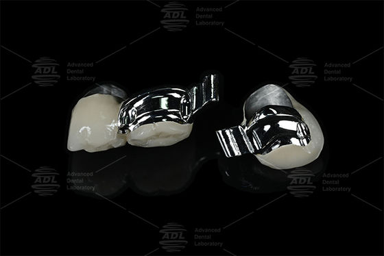 Beli China Dental Lab Disesuaikan Spesifik Pasien Keyway Precision Attachment dengan PFM pembuatan online