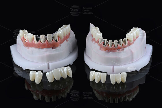 Beli China Dental Lab Titanium Full Arch Hybrid Bridge dengan Pemuatan Segera A1 Shade Malong Design Screw Retained Cad/Cam pembuatan online