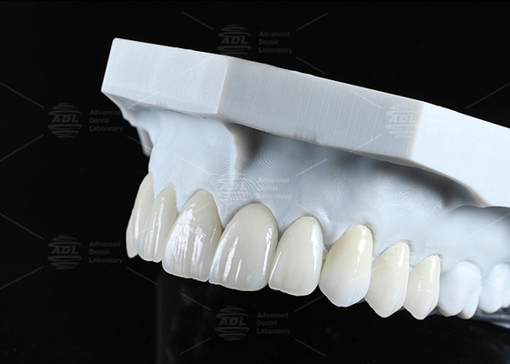 Translucency CAD EMAX Veneer Polished Glassed Ceramic Restorasi Untuk Area Bagian Depan Bagian Belakang