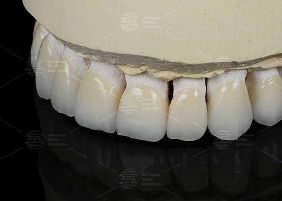 Warna Gigi Alami Seramik Feldspathic Veneer Untuk Gigi Depan dan Belakang
