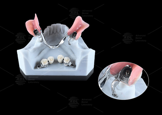 0.1mm Toleransi CEKA REVAX Attachment Titanium 3mm Peresmian Vertikal