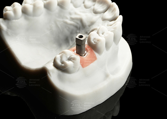 Precision Titanium Digital Implant Scan Body Sandblasted Surface Untuk Cad/Cam