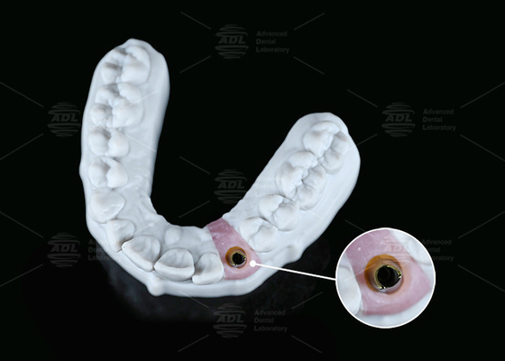 Bagian dalam Hex Custom Titanium Abutment Screw Cement Dipertahankan Bentuk Berbeda