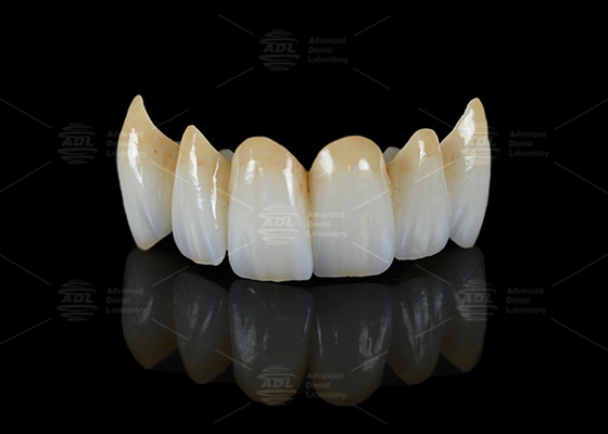 Translucence Tinggi Full Contour Zirconia Jembatan Resistensi Chipping Estetika Alam