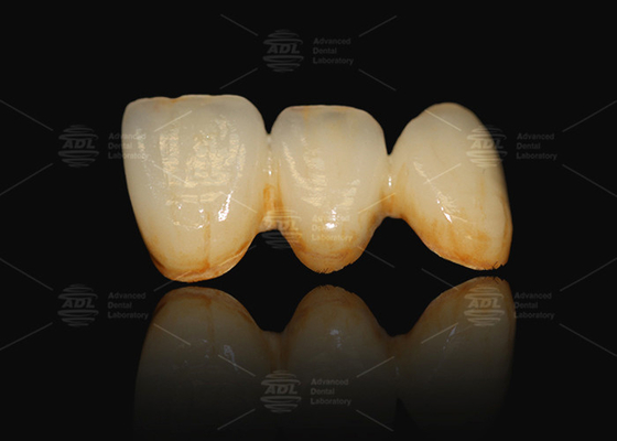 A3 A3.5 Porselen yang dilelepkan ke logam dan keramik dental crown