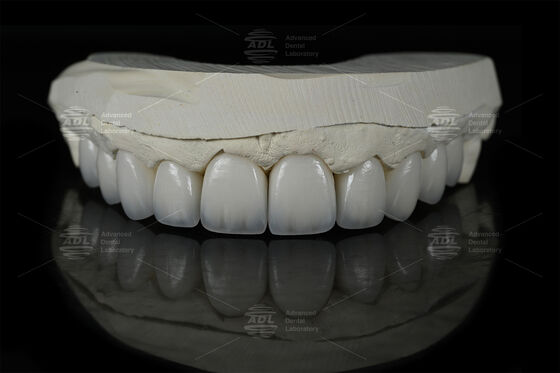 0.3mm-0.7mm Feldspathic EMAX Ceramic Veneers Natural Aesthetic Emax Dental Veneers